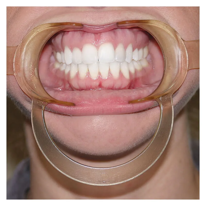 Retractor Extraoral Autoclavable, Child, Amber
