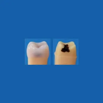 A27A-16A, Caries Tooth Model #16
