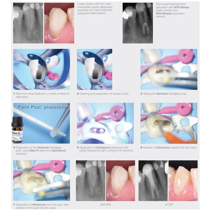 Dentocore Body Automix, Core Build-Up & Post Cementation