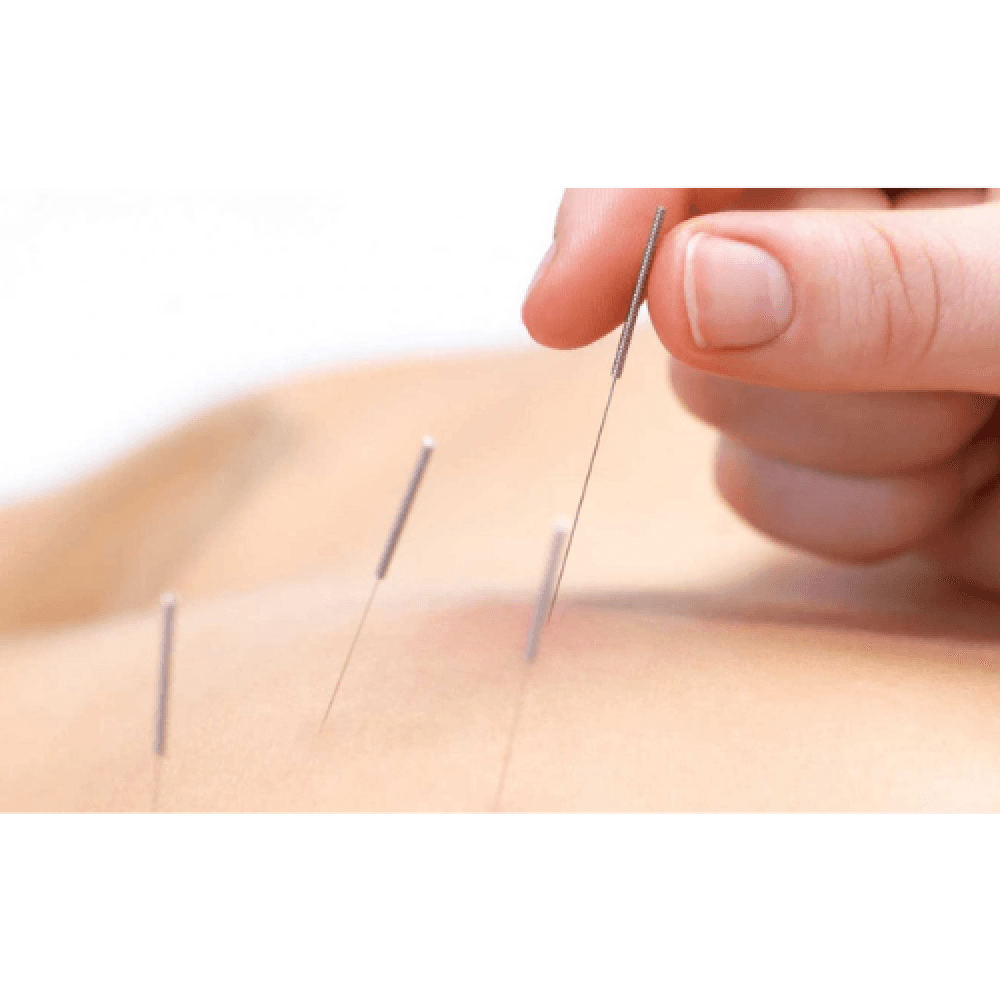 Dry Needling Needles, Sterile, 100 Needles